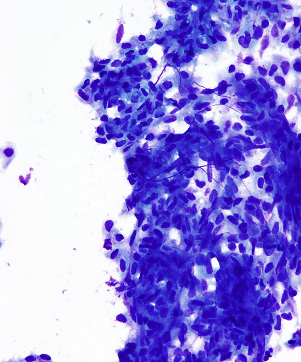 02 : GI Esophageal Squamous cell Carcinoma
