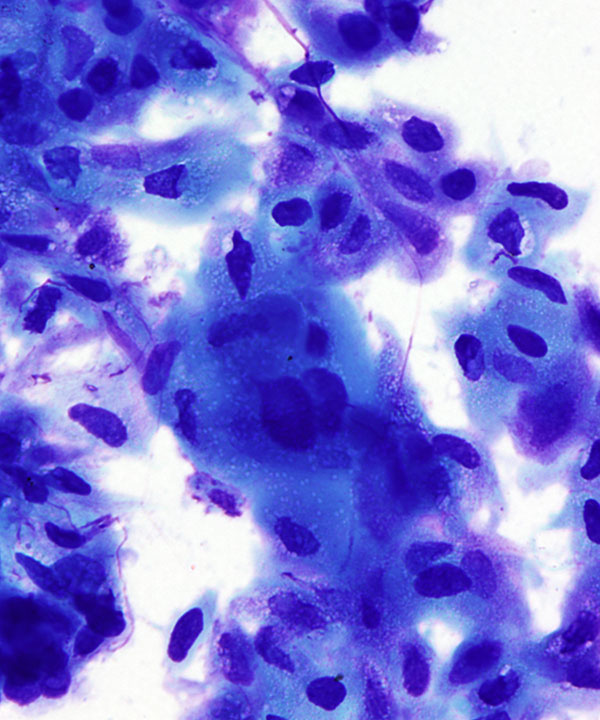 03 : GI Esophageal Squamous cell Carcinoma