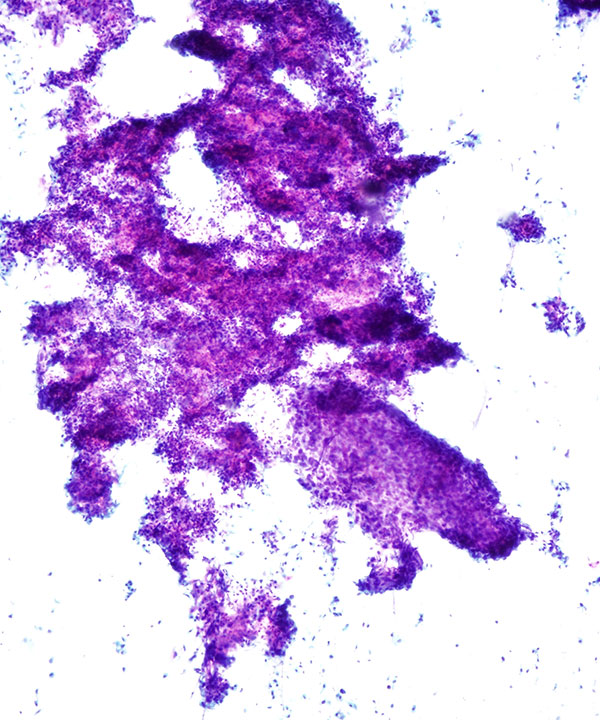 04 : GI Esophageal Squamous cell Carcinoma