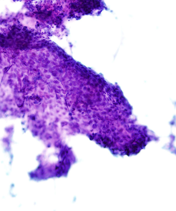 05 : GI Esophageal Squamous cell Carcinoma