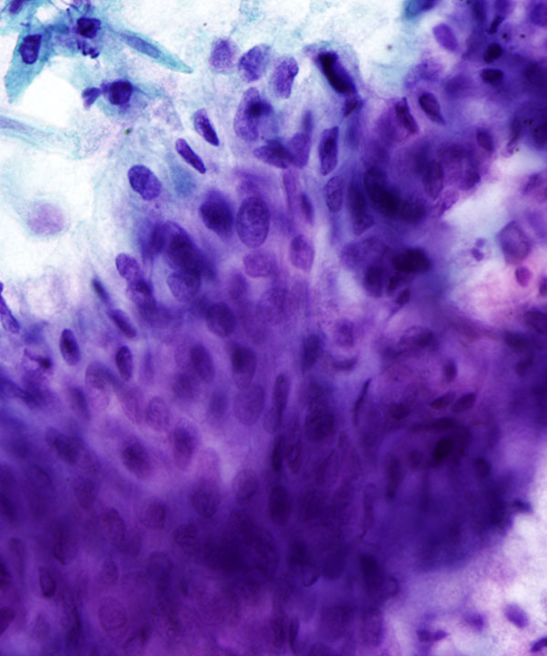 06 : GI Esophageal Squamous cell Carcinoma