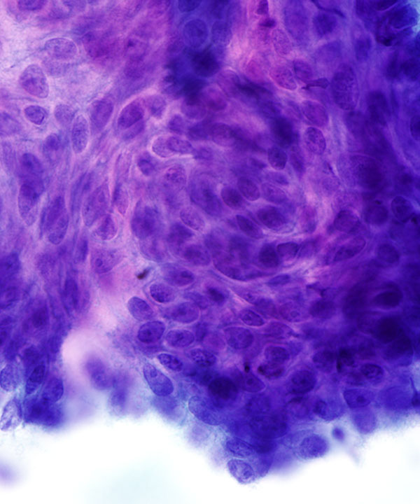 08 : GI Esophageal Squamous cell Carcinoma
