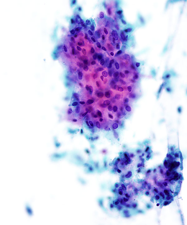 09 : GI Esophageal Squamous cell Carcinoma