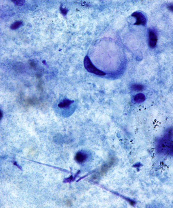 04 : Gastrointestinal Tract Gastric Adenocarcinoma