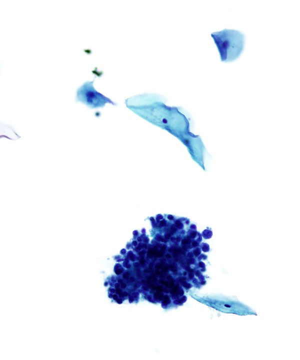 02 : Gynecologic Cytology Follicular Cervicitis