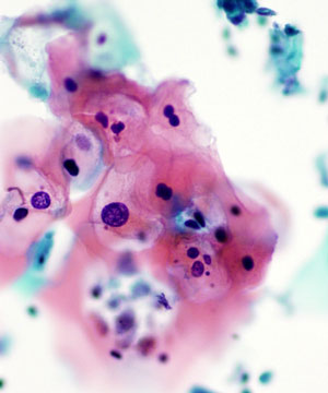 05 : Gynecologic Cytology LSIL
