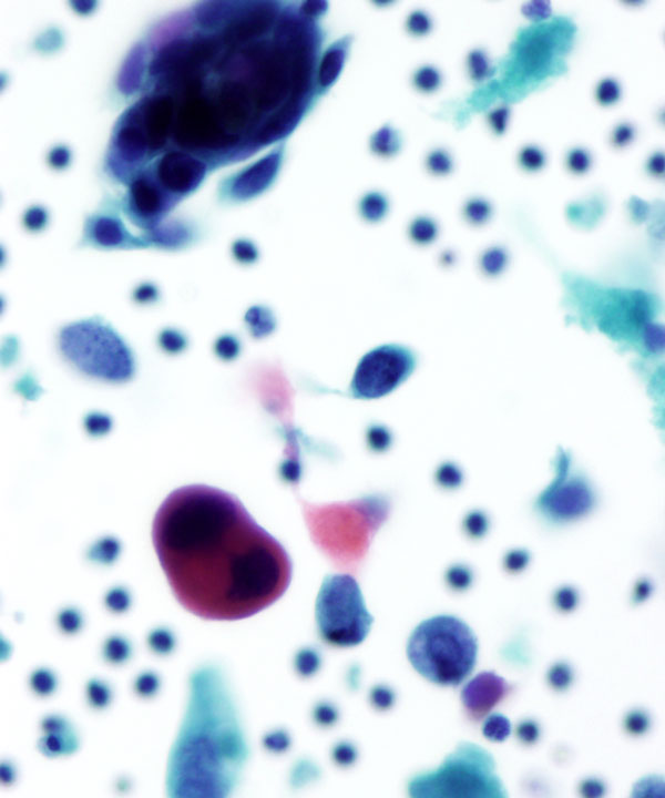 image showing 'Gynecologic Squamous Cell Carcinoma'
