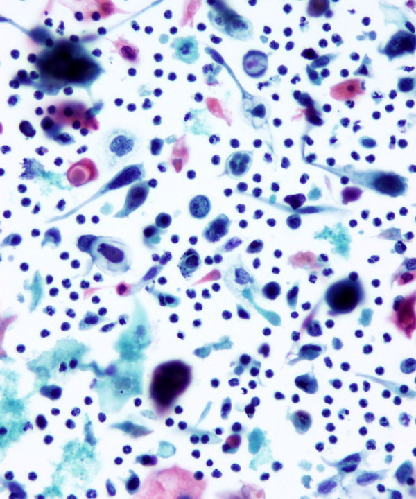04 : Gynecologic Cytology Squamous Cell Carcinoma