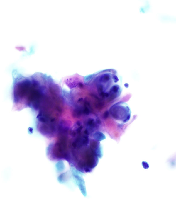 06 : Gynecologic Cytology Squamous Cell Carcinoma