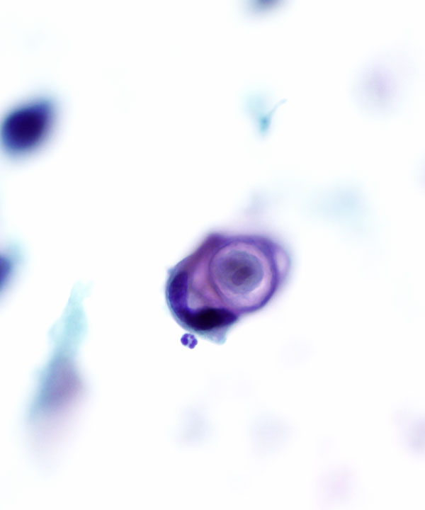 07 : Gynecologic Cytology Squamous Cell Carcinoma