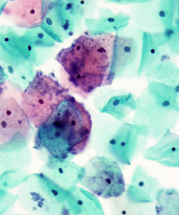 01 : Gynecologic Cytology Bacterial Vaginosis