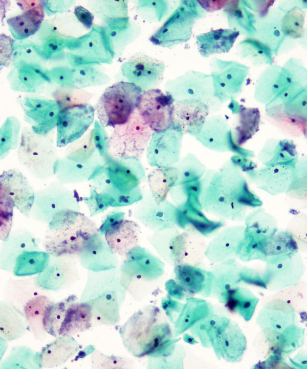 03 : Gynecologic Cytology Bacterial Vaginosis