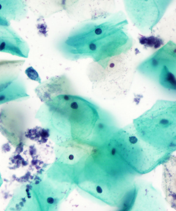 04 : Gynecologic Cytology Bacterial Vaginosis