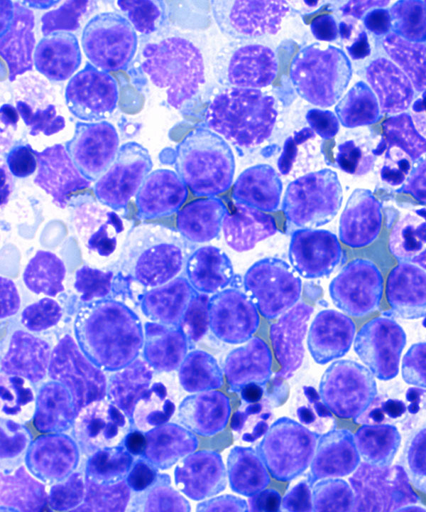 04 : Hem Burkitt Lymphoma