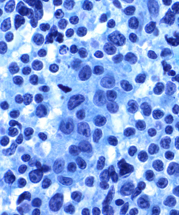 05 : Hem Follicular Lymphoma