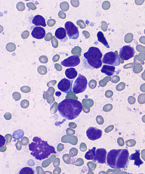 03 : HemMantle Cell Lymphoma