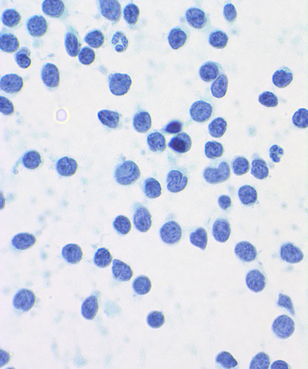 04 : HemMantle Cell Lymphoma