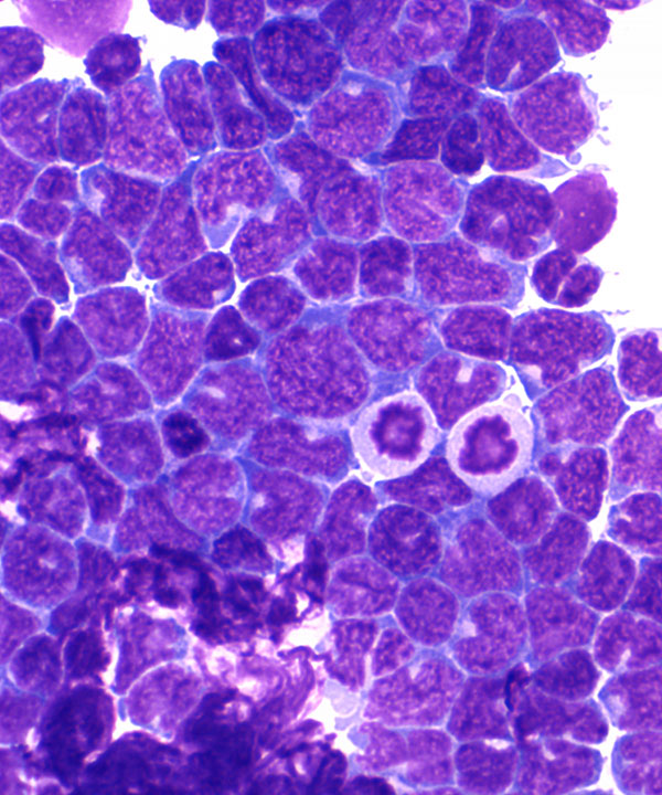 08 : HemMantle Cell Lymphoma
