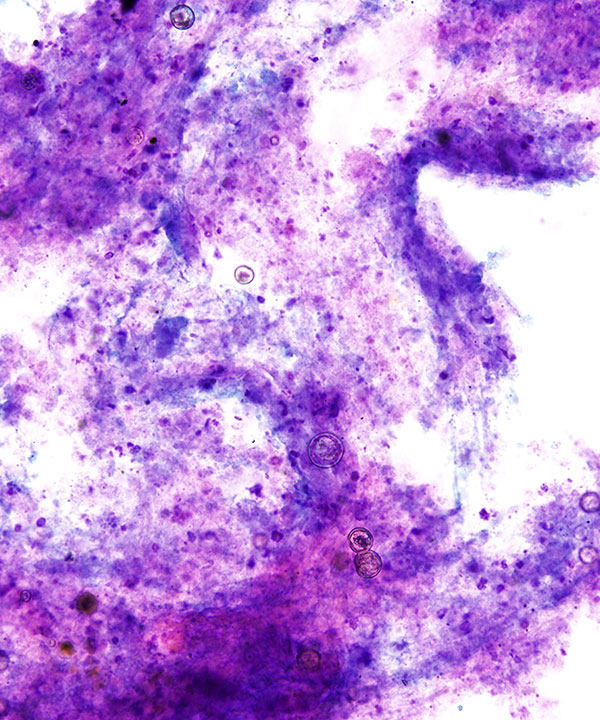 image showing 'Coccidiodomycosis'