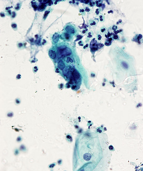 image showing 'Herpes Virus Infection'