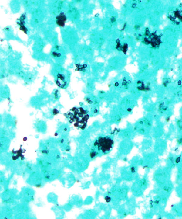 image showing 'Histoplasmosis'