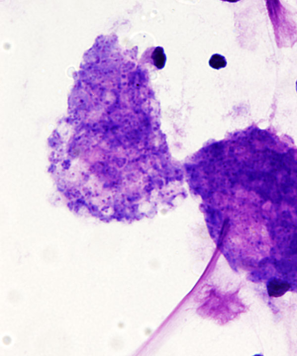 image showing 'Pneumocystis Pneumonia'