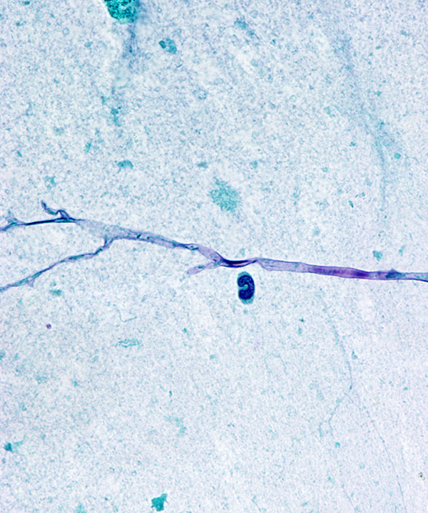 image showing 'Zygomycosis'