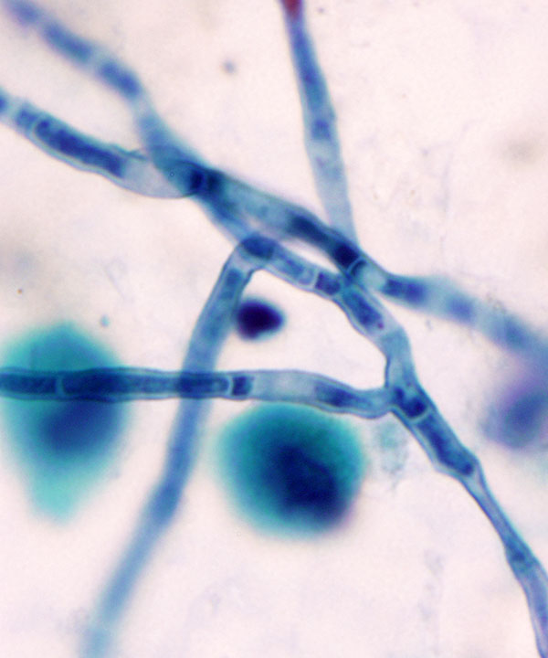 2 :  Infectious Diseases Aspergillosis