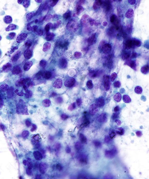 image showing 'Blastomycosis'