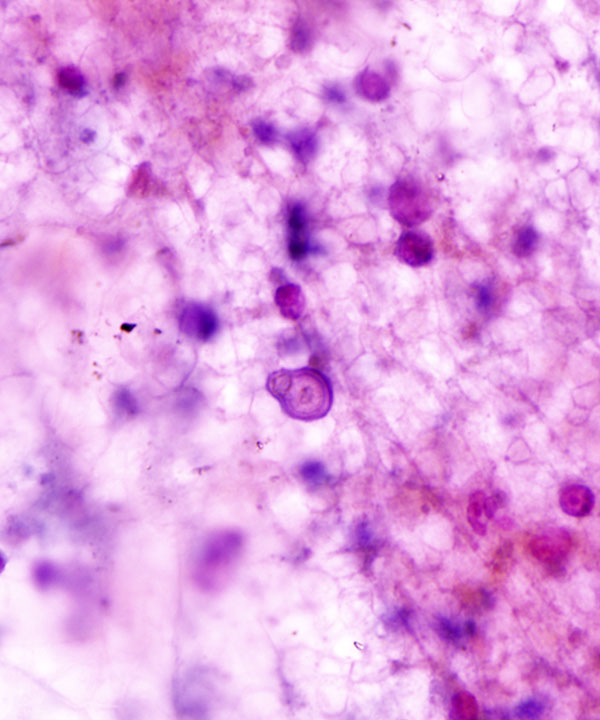 2 :  Infectious Diseases Blastomycosis