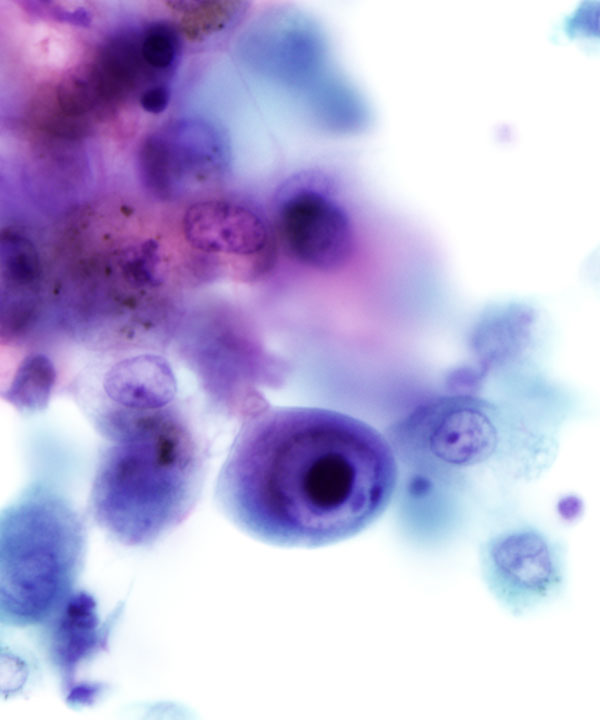 image showing 'Cytomegalovirus Infection'
