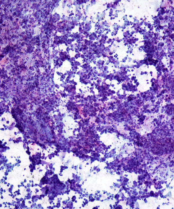 image showing 'Chromophobe Renal Cell Carcinoma'