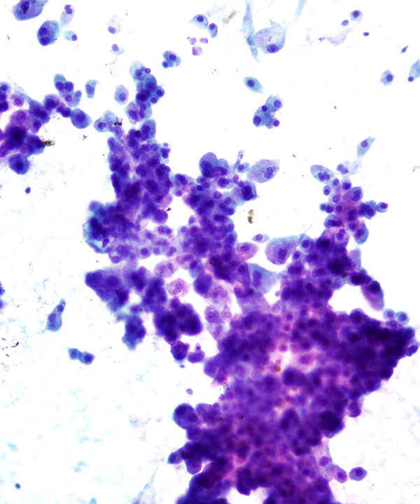 2 :  Chromophobe Renal Cell Carcinoma