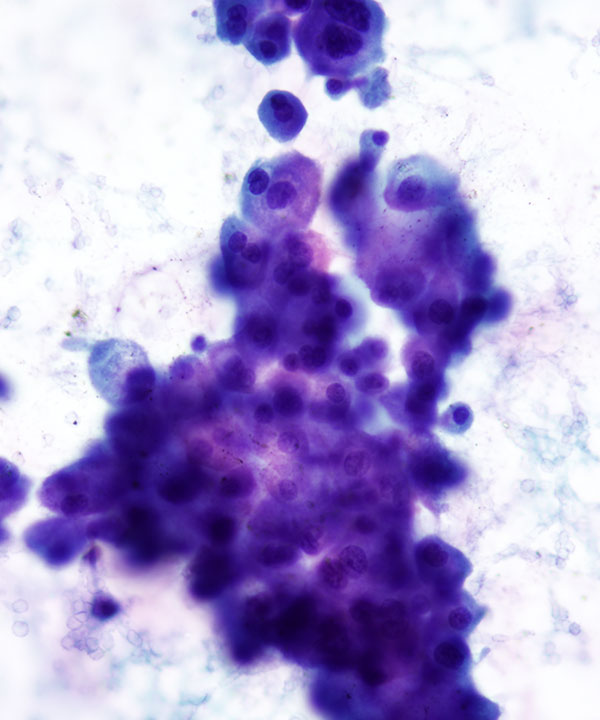 3 :  Chromophobe Renal Cell Carcinoma