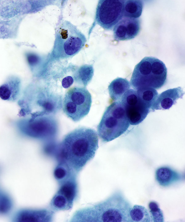4 :  Chromophobe Renal Cell Carcinoma