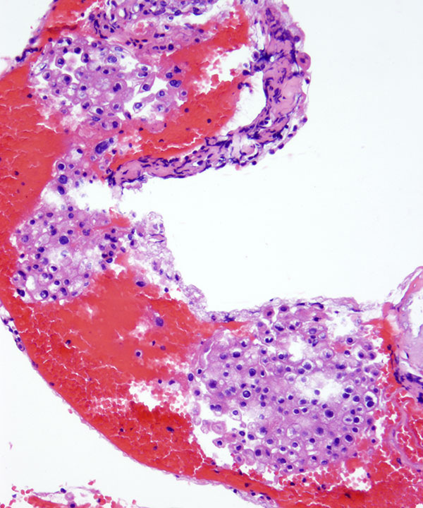 5 :  Chromophobe Renal Cell Carcinoma