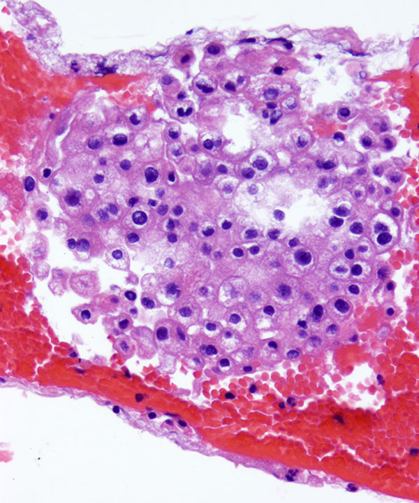 6 :  Chromophobe Renal Cell Carcinoma