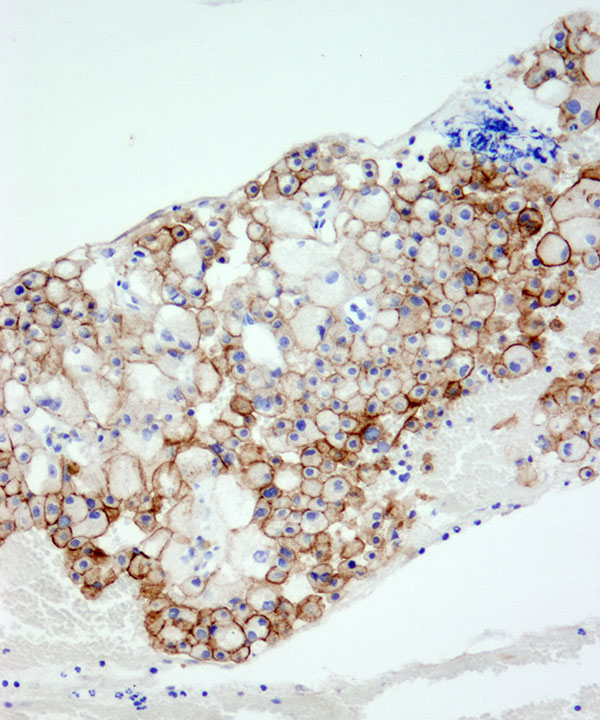 7 :  Chromophobe Renal Cell Carcinoma