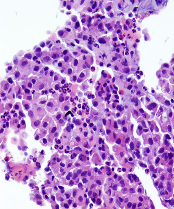 image showing 'Oncocytoma'