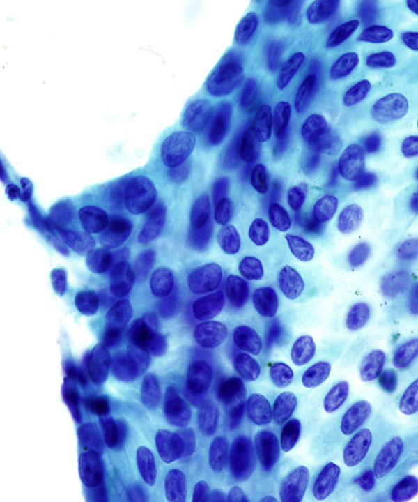 image showing 'Papillary Renal Cell Carcinoma - type I'
