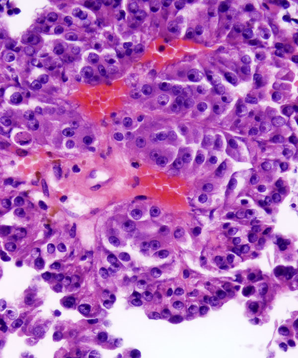 image showing 'Papillary Renal Cell Carcinoma - type II'