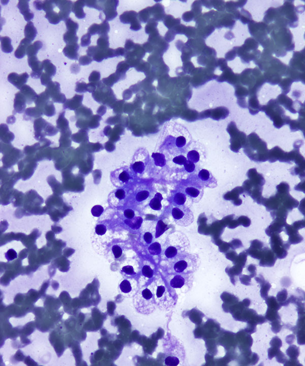 1 : Renal Cell Carcinoma Clear Cell
