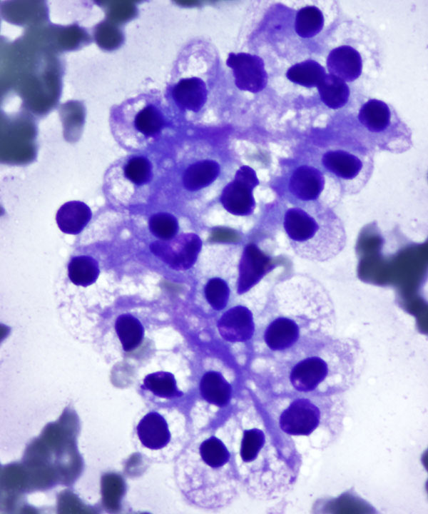 2 : Renal Cell Carcinoma Clear Cell