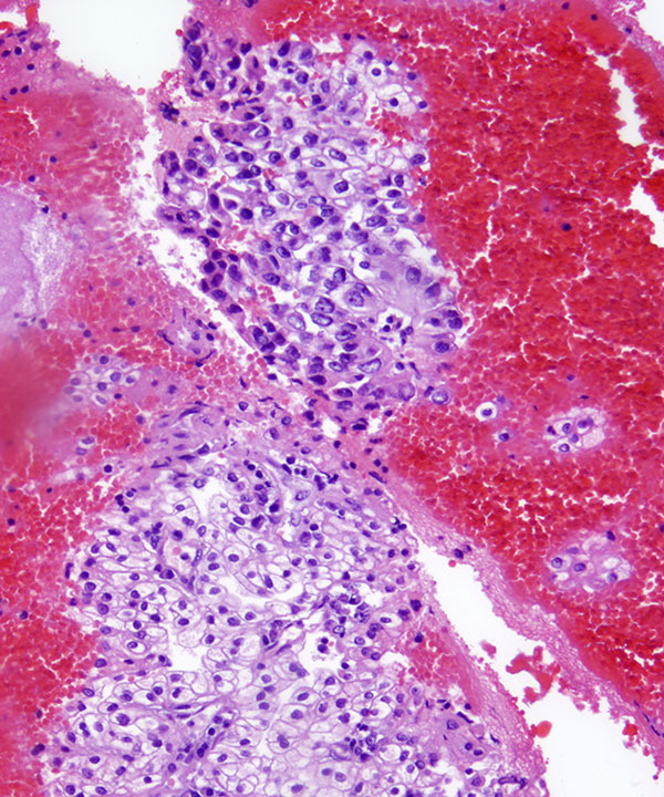 7 : Renal Cell Carcinoma Clear Cell