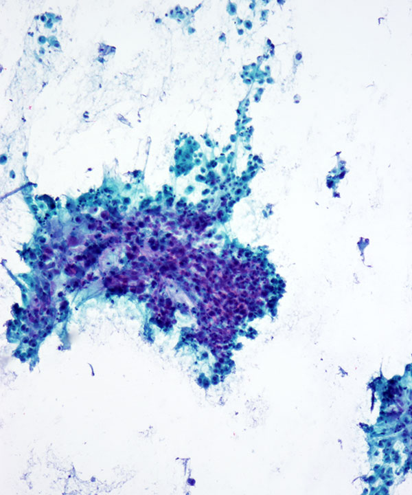 image showing 'Sarcomatoid Carcinoma'