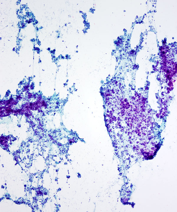 03 : Kidney TranslocationRCC