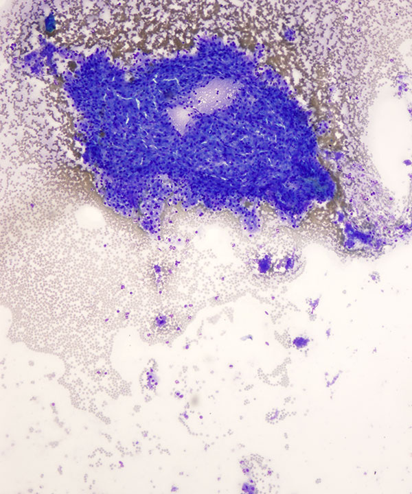 image showing 'Liver Adenoma'