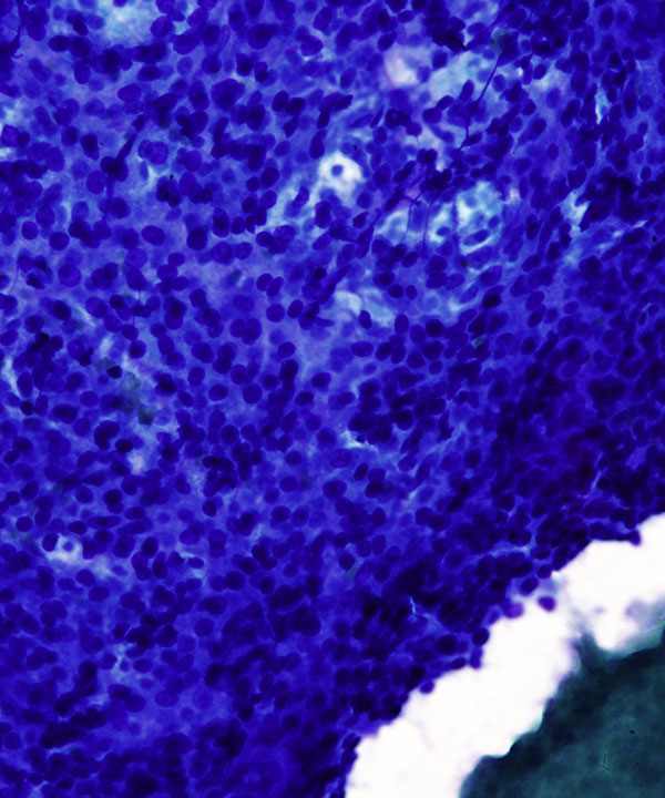 02 : Liver Hepatocellular Carcinoma