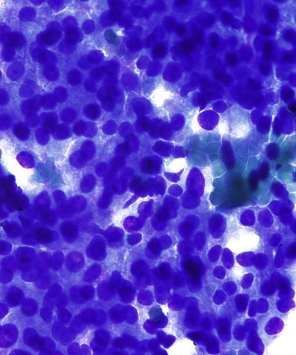 03 : Liver Hepatocellular Carcinoma