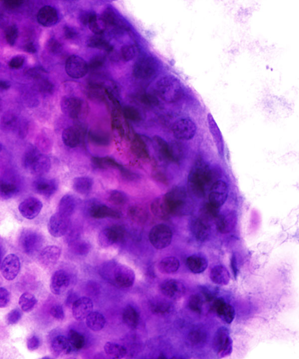 06 : Liver Hepatocellular Carcinoma